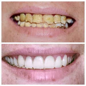 Before and after dental treatment photo