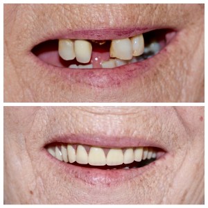 Before and after dental treatment photo