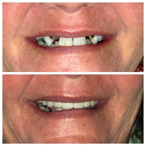 Before and after dental treatment photo