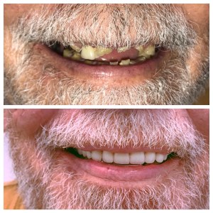 Before and after dental treatment photo