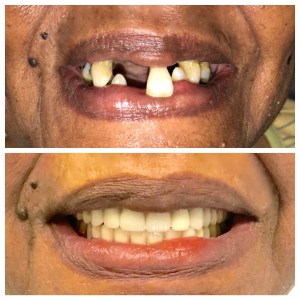 Before and after dental treatment photo