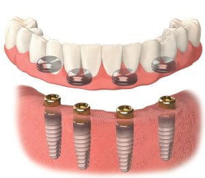 Digital illustration of the 4-implant overdenture