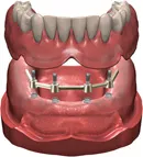 Digital illustration of the 4-implant overdenture with a bar