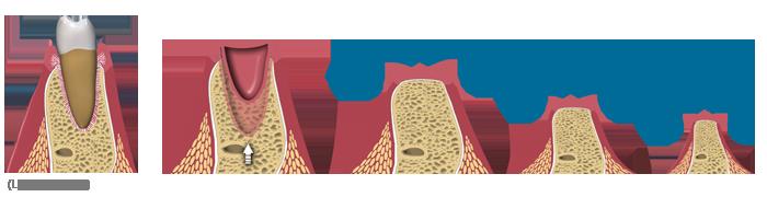 Digital illustration of the gum and bone after tooth extraction