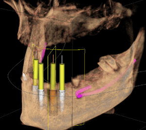 3D imaging of dental implants