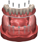 Digital illustration of the fixed hybrid denture