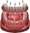 Digital illustration of the fixed hybrid denture