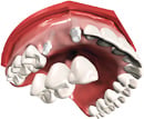 Digital illustration of an implant-supported dental bridge