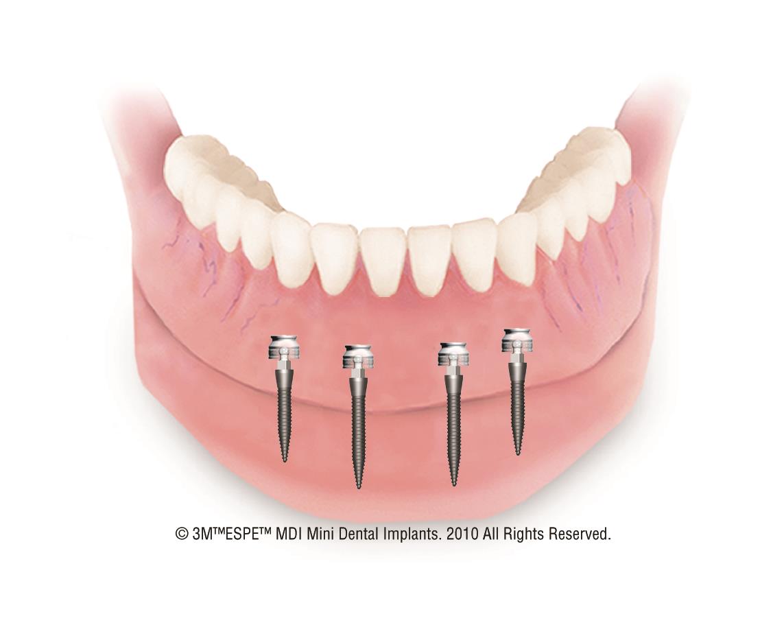 Miniimplant overdenture Rocky Mount NC DentureCare & Implants