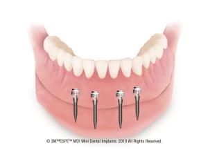 Digital illustration of the mini-implant overdenture