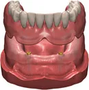 Digital illustration of the 2-implant overdenture