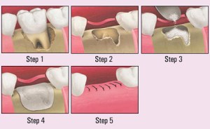 Digital illustration of the socket preservation process