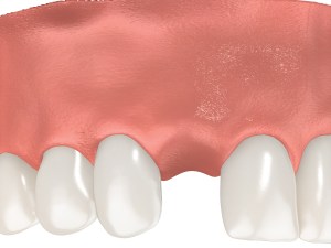 Upper jaw and gums missing one tooth 