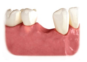 Lower jaw and gums missing one tooth