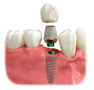 Lower jaw receiving an implant and crown 