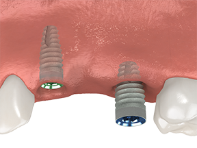 implant screws shown inside the gums of  the upper jaw