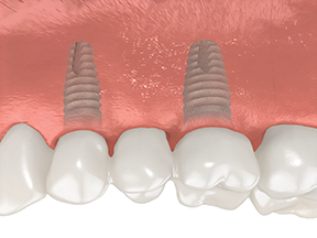Crowns are placed on top of the screws implanted in the gums 