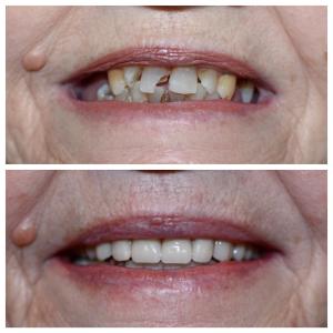 Before and after dental treatment photo