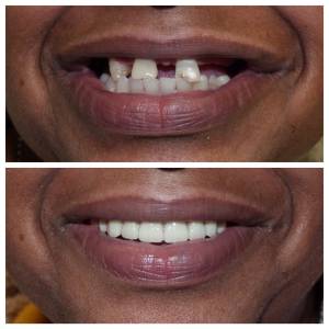 Before and after dental treatment photo
