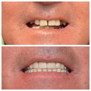 Before and after dental treatment photo